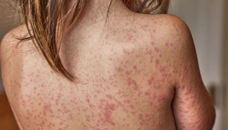 ROUGEOLE : L’ARS APPELLE À VÉRIFIER SA VACCINATION FACE À LA REPRISE DU VIRUS